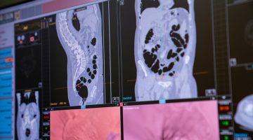 Colonscopia Virtuale