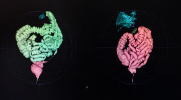 Colonscopia Virtuale