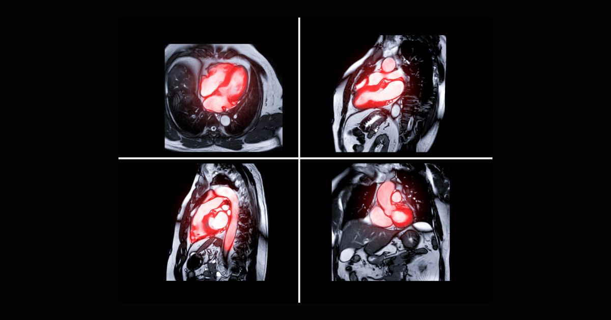 Risonanza Magnetica Cardiaca